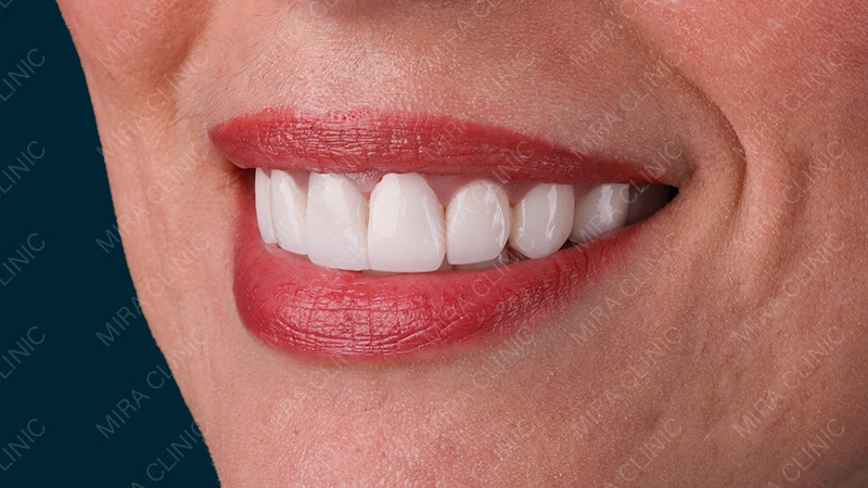 Hollywood smile results